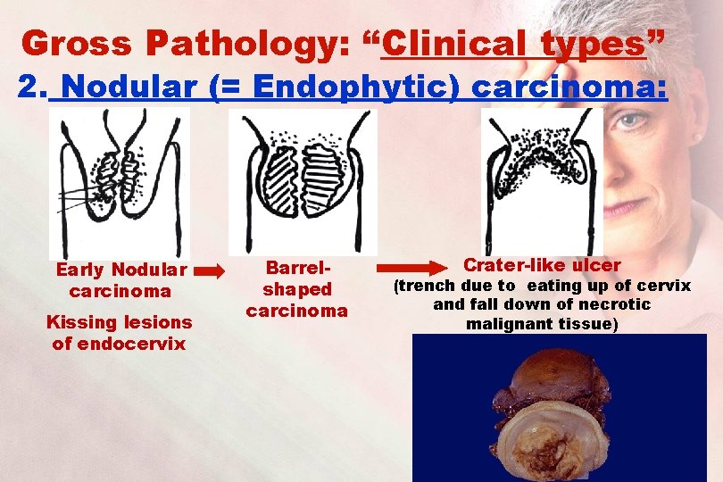 Gross Pathology: “Clinical types” 2. Nodular (= Endophytic) carcinoma: Early Nodular carcinoma Kissing lesions