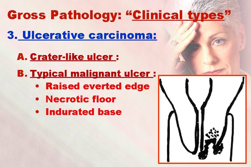 Gross Pathology: “Clinical types” 3. Ulcerative carcinoma: A. Crater-like ulcer : B. Typical malignant