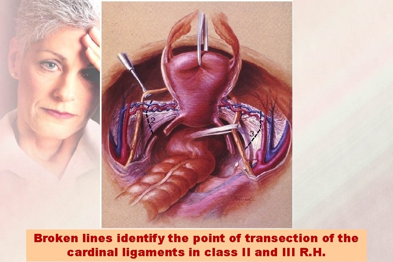 Broken lines identify the point of transection of the cardinal ligaments in class II