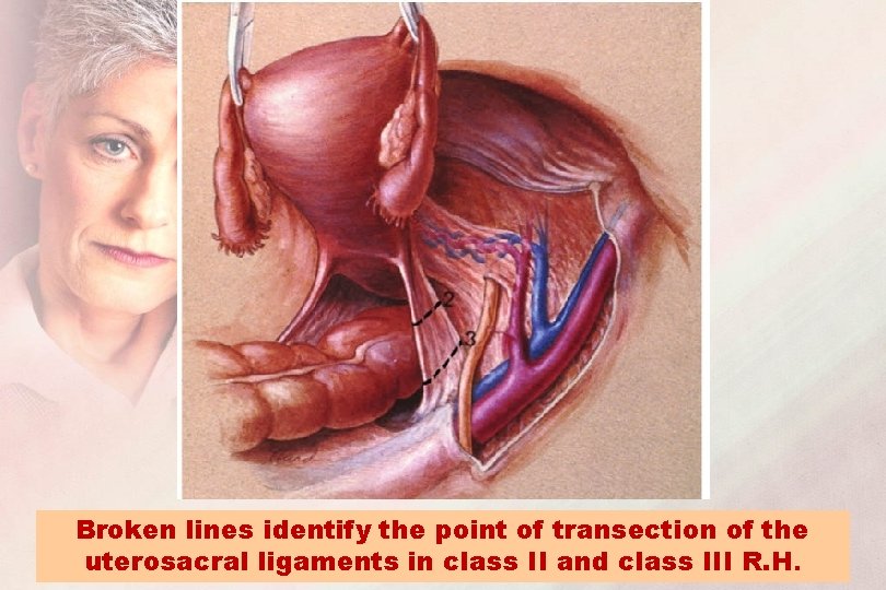 Broken lines identify the point of transection of the uterosacral ligaments in class II
