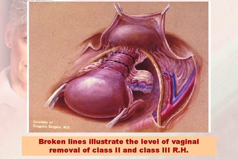 Broken lines illustrate the level of vaginal removal of class II and class III