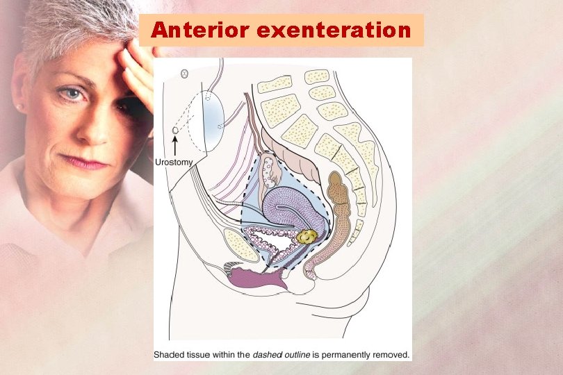 Anterior exenteration 
