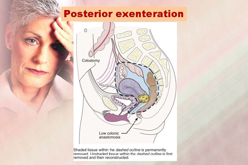 Posterior exenteration 