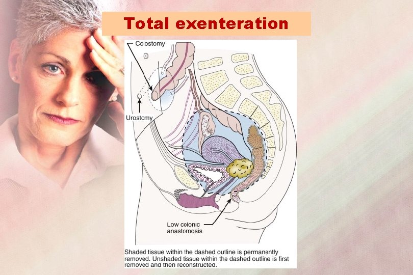 Total exenteration 