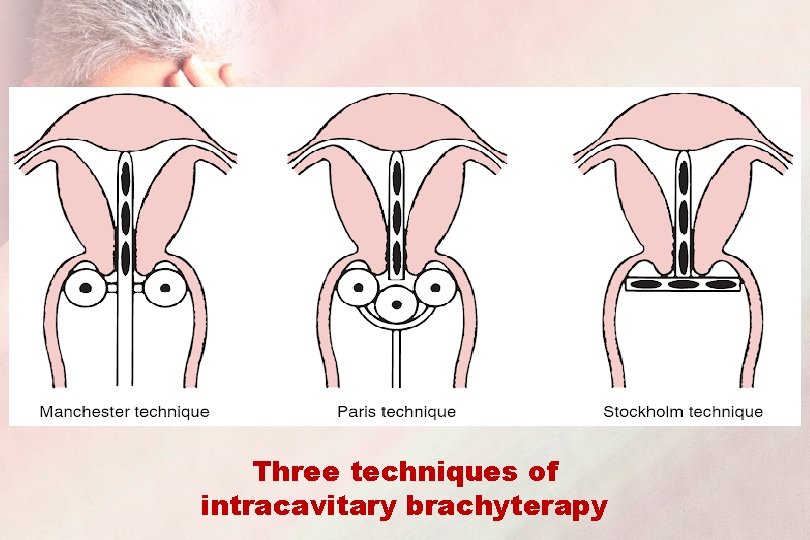 Three techniques of intracavitary brachyterapy 