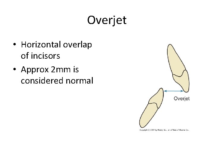 Overjet • Horizontal overlap of incisors • Approx 2 mm is considered normal 