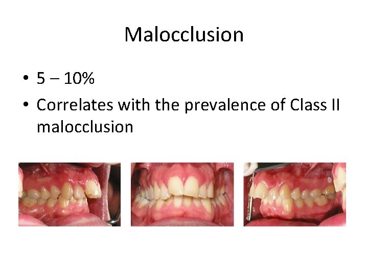 Malocclusion • 5 – 10% • Correlates with the prevalence of Class II malocclusion