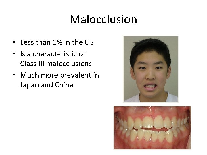 Malocclusion • Less than 1% in the US • Is a characteristic of Class