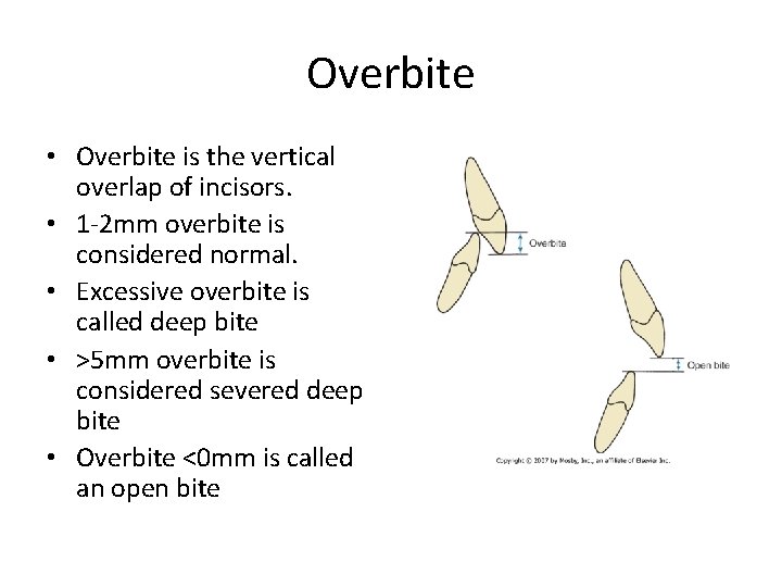 Overbite • Overbite is the vertical overlap of incisors. • 1 -2 mm overbite