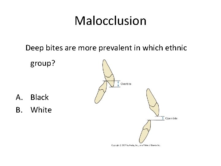 Malocclusion Deep bites are more prevalent in which ethnic group? A. Black B. White
