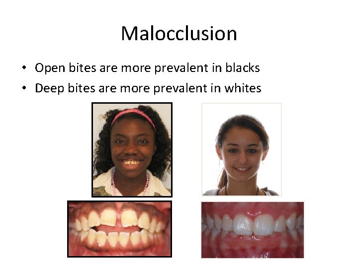 Malocclusion • Open bites are more prevalent in blacks • Deep bites are more