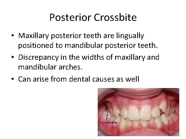 Posterior Crossbite • Maxillary posterior teeth are lingually positioned to mandibular posterior teeth. •