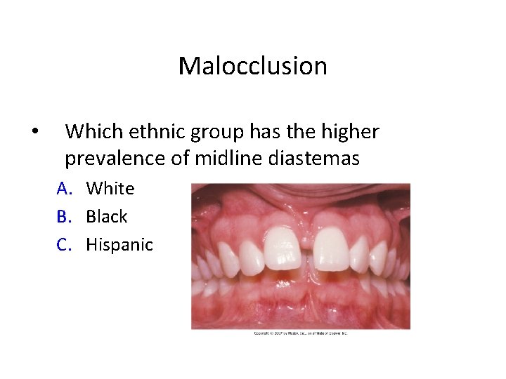 Malocclusion • Which ethnic group has the higher prevalence of midline diastemas A. White