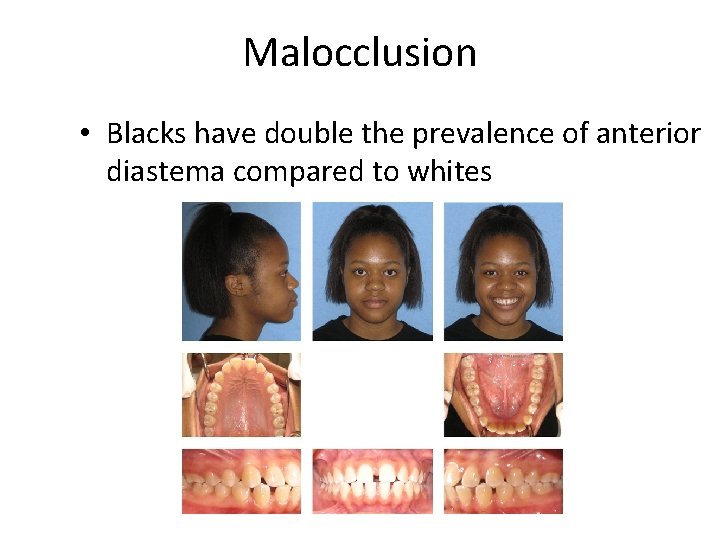 Malocclusion • Blacks have double the prevalence of anterior diastema compared to whites 