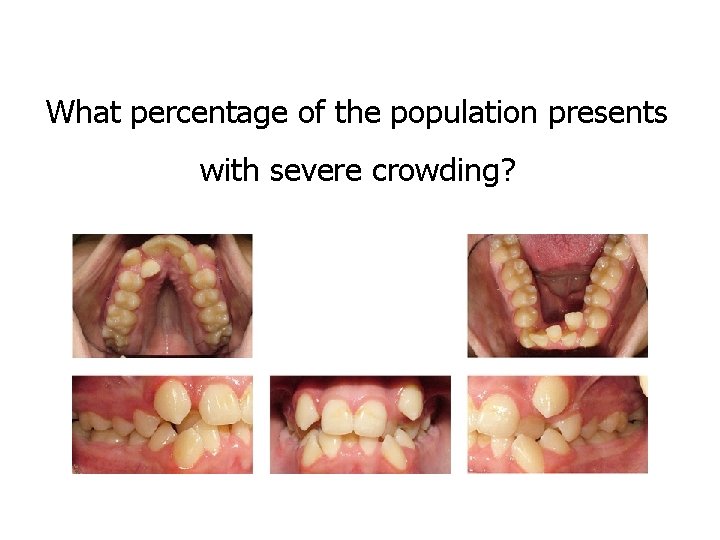 What percentage of the population presents with severe crowding? 