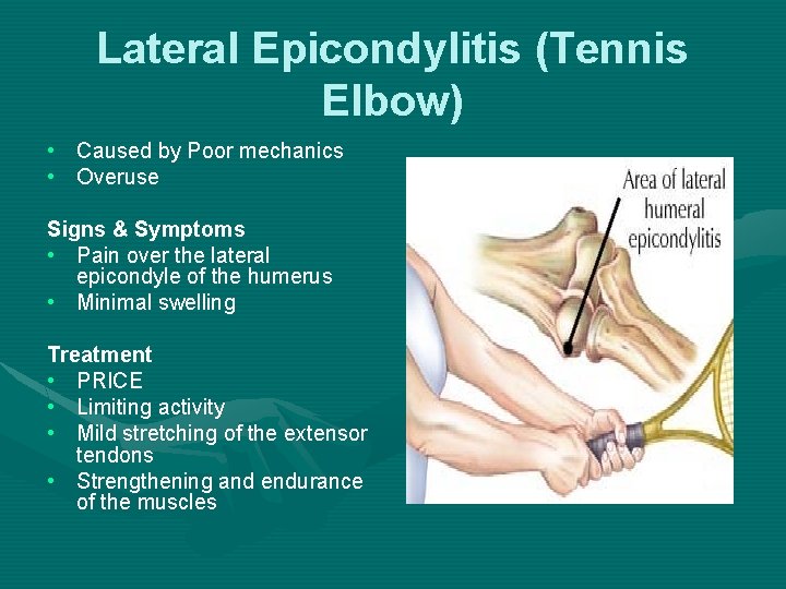 Lateral Epicondylitis (Tennis Elbow) • Caused by Poor mechanics • Overuse Signs & Symptoms