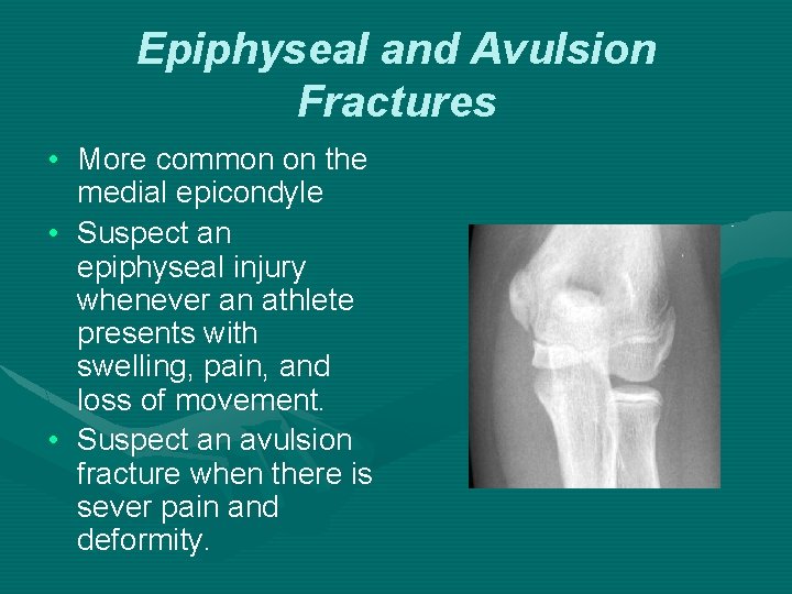 Epiphyseal and Avulsion Fractures • More common on the medial epicondyle • Suspect an