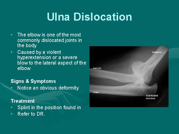 Ulna Dislocation • The elbow is one of the most commonly dislocated joints in