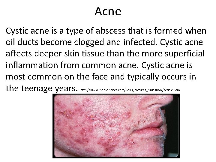 Acne Cystic acne is a type of abscess that is formed when oil ducts