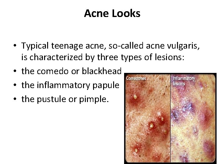 Acne Looks • Typical teenage acne, so-called acne vulgaris, is characterized by three types