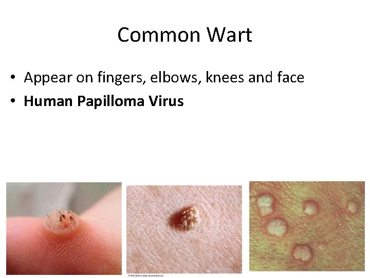 Common Wart • Appear on fingers, elbows, knees and face • Human Papilloma Virus