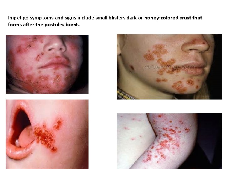 Impetigo symptoms and signs include small blisters dark or honey-colored crust that forms after