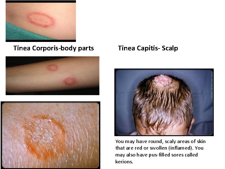 Tinea Corporis-body parts Tinea Capitis- Scalp You may have round, scaly areas of skin