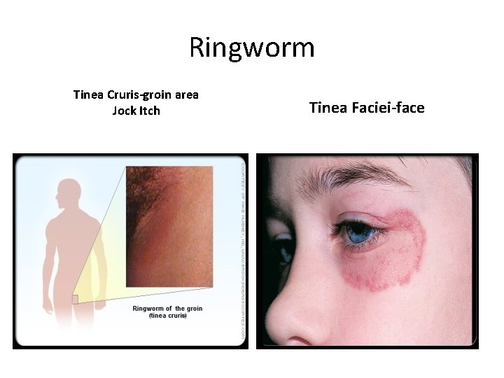 Ringworm Tinea Cruris-groin area Jock Itch Tinea Faciei-face 