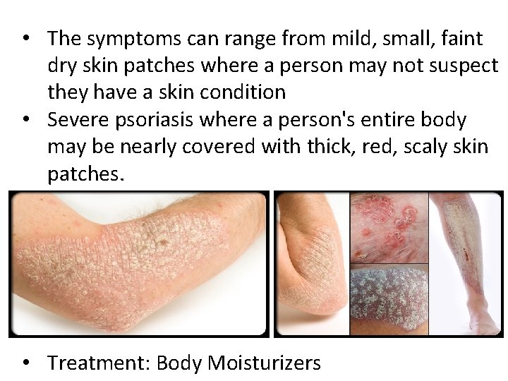  • The symptoms can range from mild, small, faint dry skin patches where