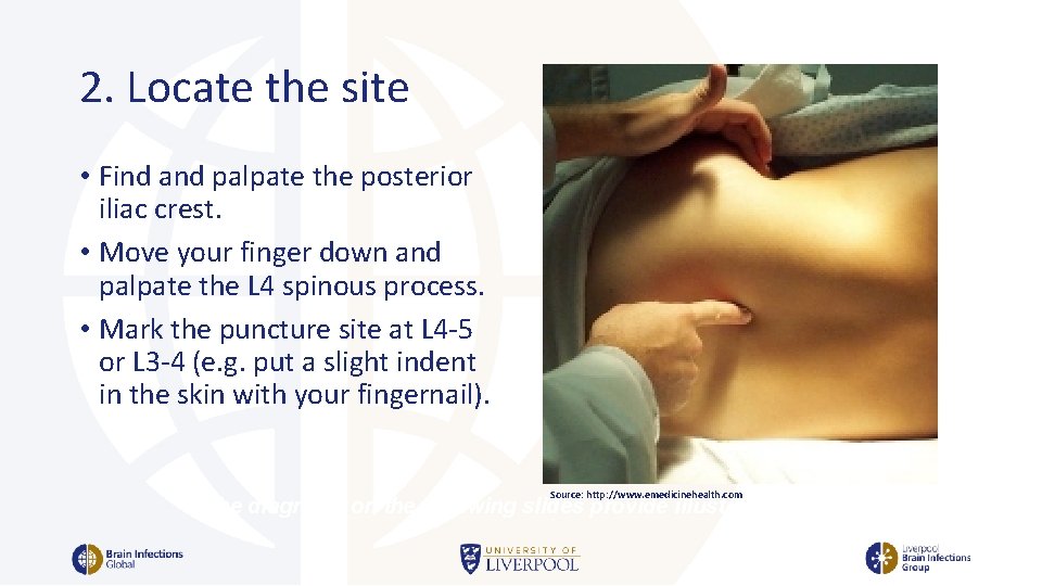 2. Locate the site • Find and palpate the posterior iliac crest. • Move