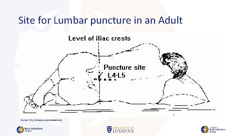 Site for Lumbar puncture in an Adult Source: http: //www. postgradmed. com 