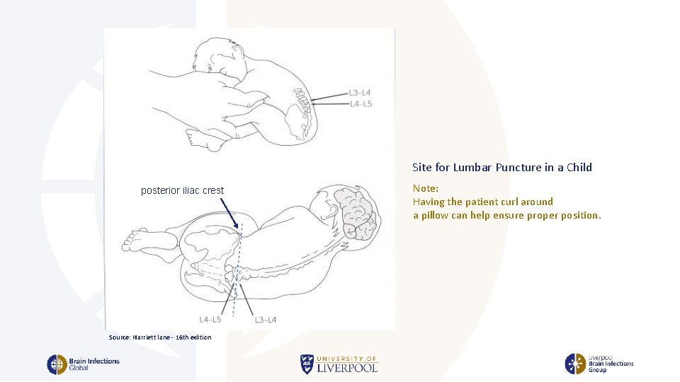 Site for Lumbar Puncture in a Child posterior iliac crest Source: Harriett lane -