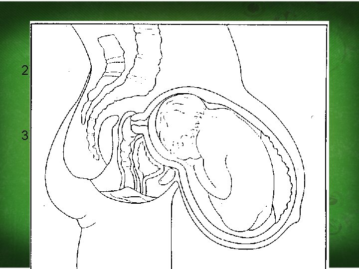 2)Maternal kyphosis: The convexity of the foetal back fits with the concavity of the