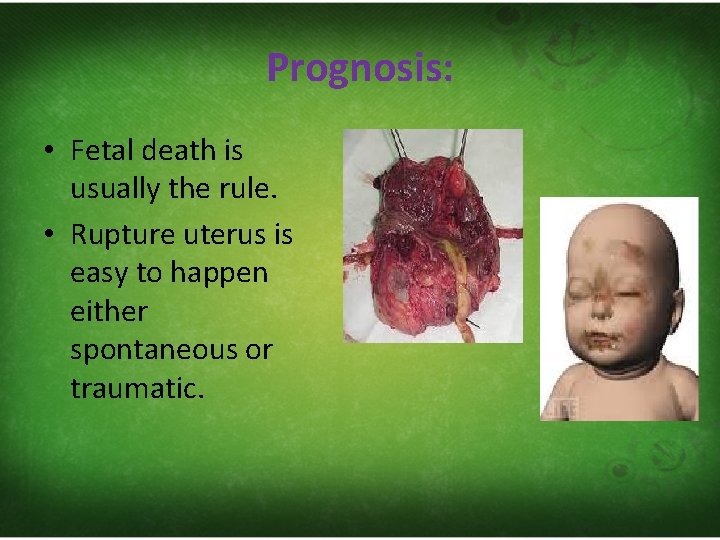 Prognosis: • Fetal death is usually the rule. • Rupture uterus is easy to