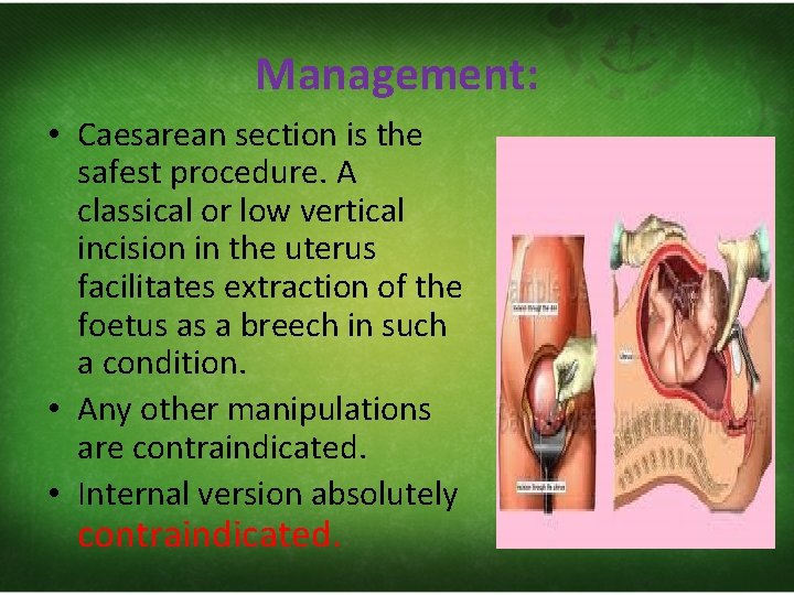 Management: • Caesarean section is the safest procedure. A classical or low vertical incision
