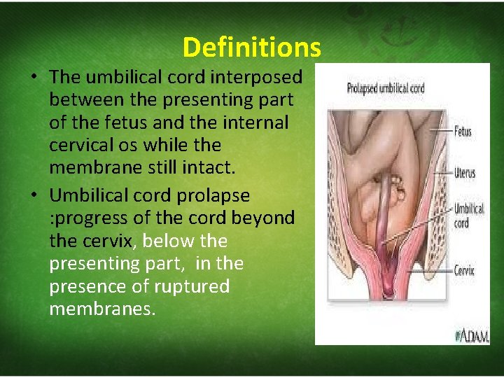 Definitions • The umbilical cord interposed between the presenting part of the fetus and