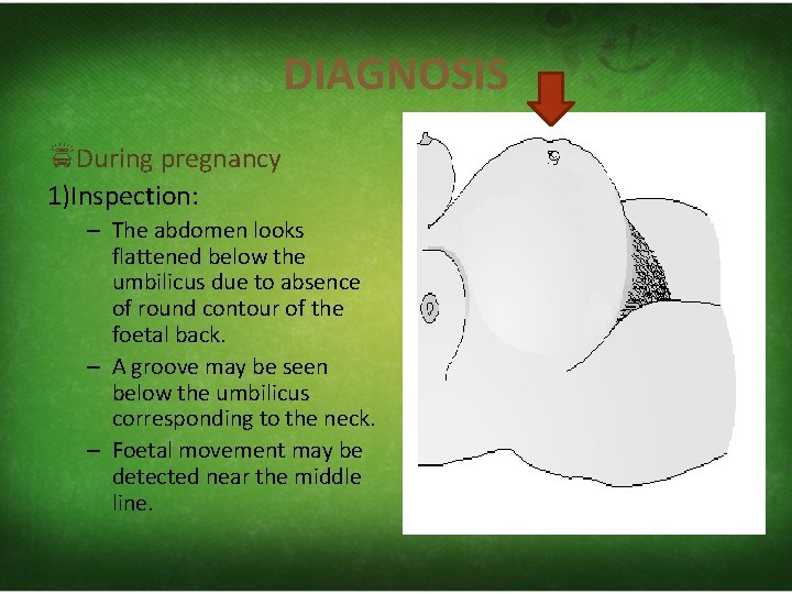 DIAGNOSIS During pregnancy 1)Inspection: – The abdomen looks flattened below the umbilicus due to