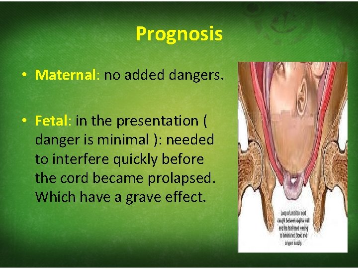 Prognosis • Maternal: no added dangers. • Fetal: in the presentation ( danger is