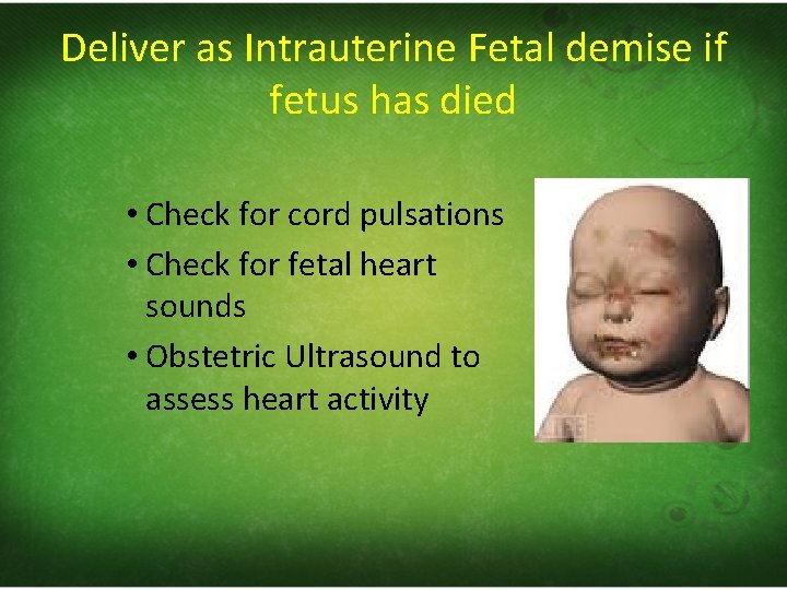 Deliver as Intrauterine Fetal demise if fetus has died • Check for cord pulsations