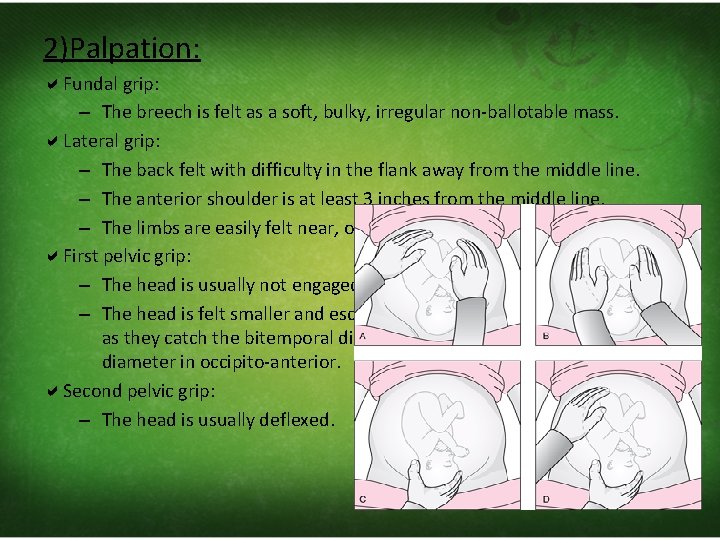 2)Palpation: Fundal grip: – The breech is felt as a soft, bulky, irregular non‐ballotable