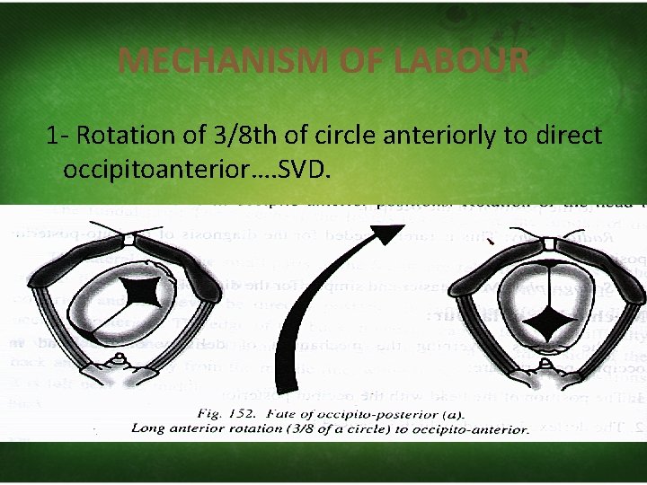 MECHANISM OF LABOUR 1‐ Rotation of 3/8 th of circle anteriorly to direct occipitoanterior….