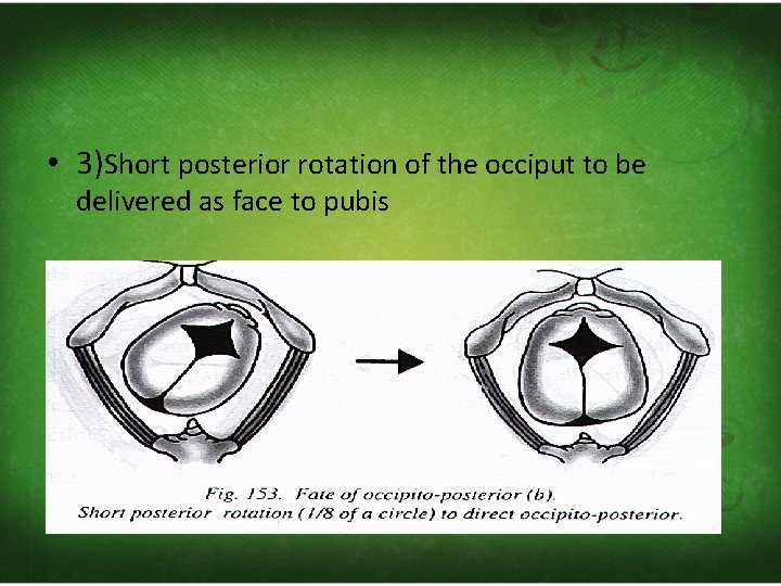  • 3)Short posterior rotation of the occiput to be delivered as face to