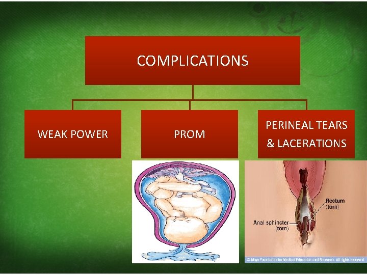 COMPLICATIONS WEAK POWER PROM PERINEAL TEARS & LACERATIONS 