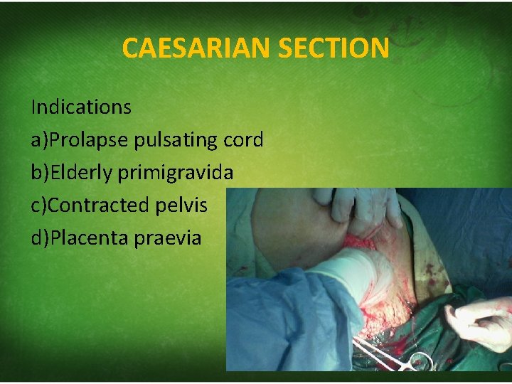 CAESARIAN SECTION Indications a)Prolapse pulsating cord b)Elderly primigravida c)Contracted pelvis d)Placenta praevia 