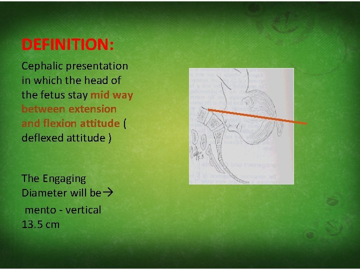 DEFINITION: Cephalic presentation in which the head of the fetus stay mid way between