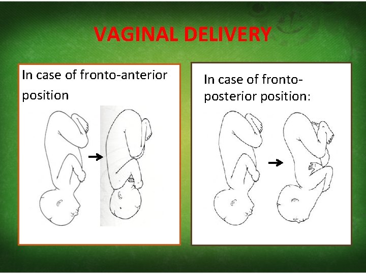 VAGINAL DELIVERY In case of fronto‐anterior position In case of fronto‐ posterior position: 