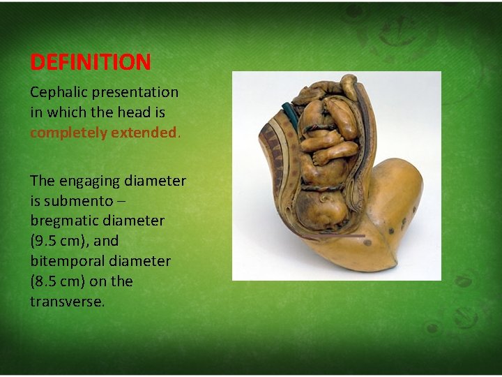 DEFINITION Cephalic presentation in which the head is completely extended. The engaging diameter is