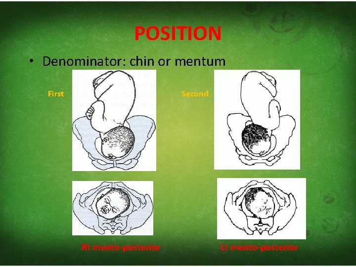 POSITION • Denominator: chin or mentum First Second Rt mento-posterior Lt mento-posterior 