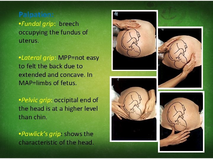 Palpation: • Fundal grip: breech occupying the fundus of uterus. • Lateral grip: MPP=not