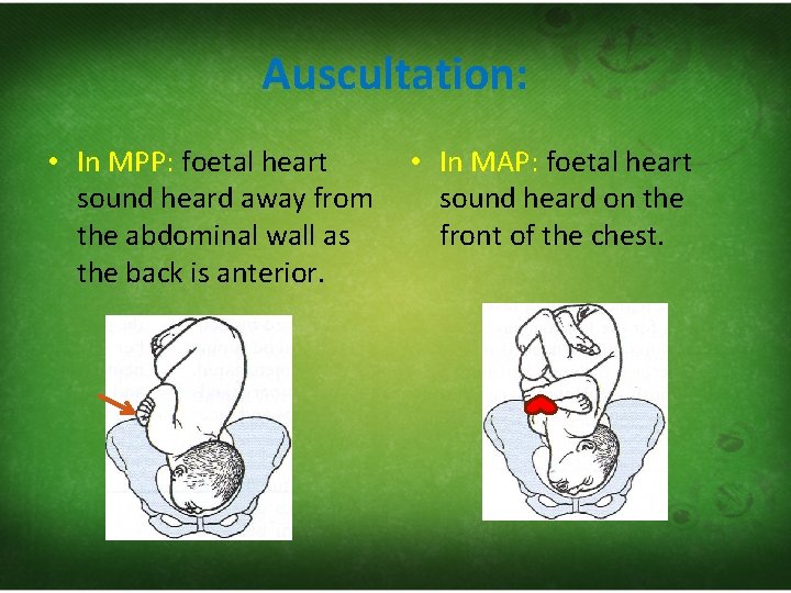 Auscultation: • In MPP: foetal heart sound heard away from the abdominal wall as